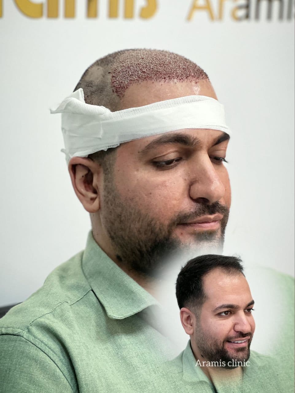 نمونه کار کاشت مو 2