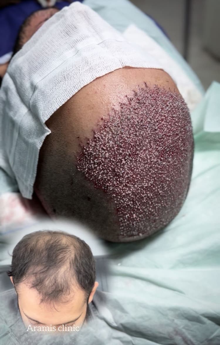 تصویر 1 - نمونه کار کاشت مو 4