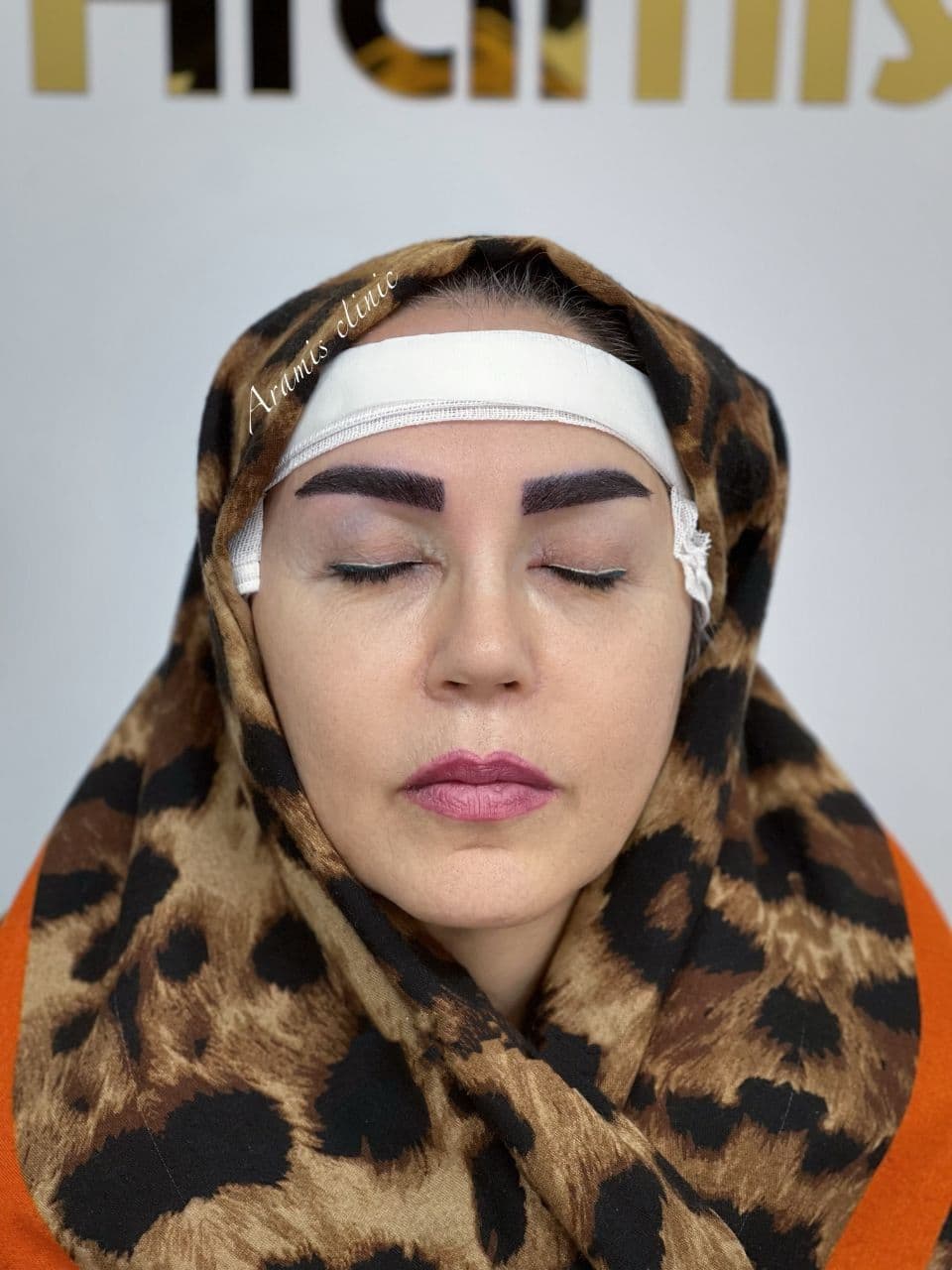 کاشت ابرو 