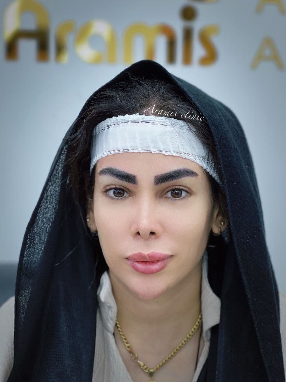 کاشت ابرو