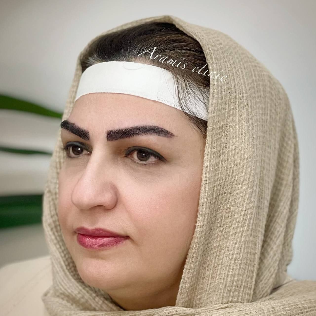 کاشت ابرو